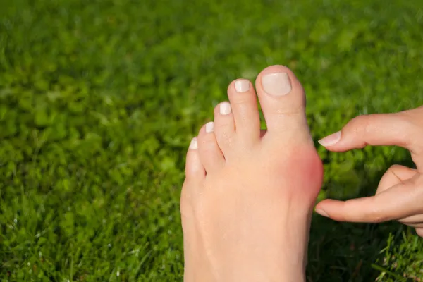 bunions