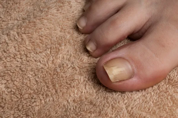 Fungal Nails vs. Nail Psoriasis: How to Tell the Difference