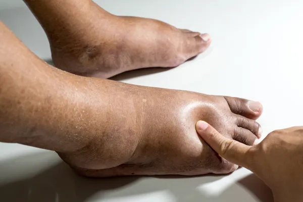 Transforming Nerve Pain: How Our Podiatry Care Eases Diabetic Neuropathy
