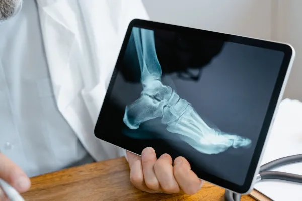 What Is Charcot Foot? A Simple Guide for Diabetics