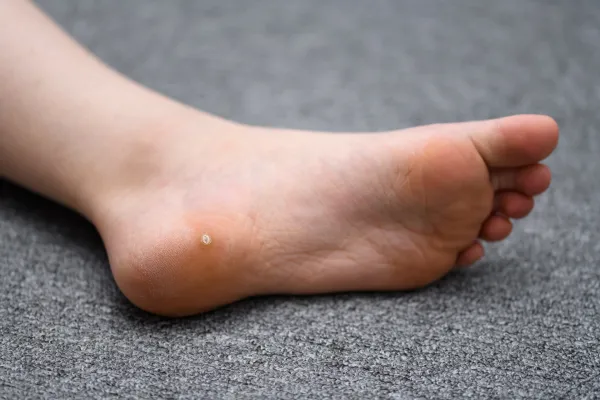 A Smarter Way to Treat Plantar Warts (Without Freezing, Cutting, or Fuss)