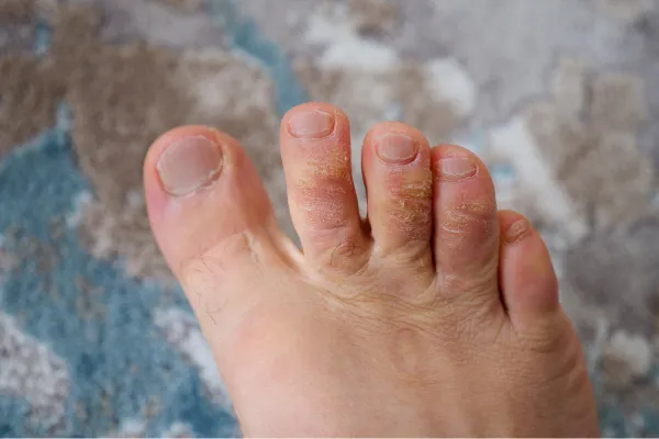 Can Laser Therapy Help Clear Up Fungal Toenails?