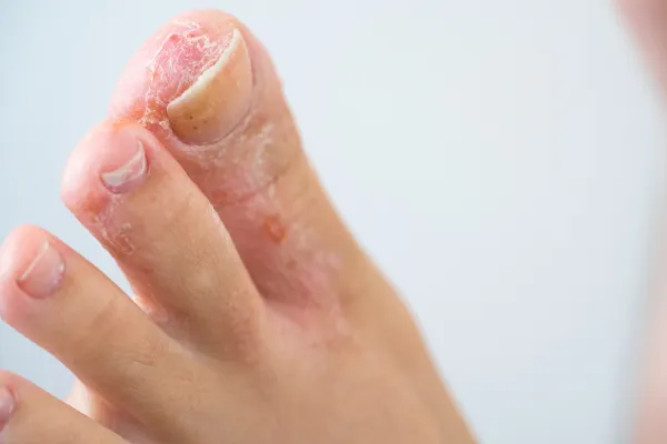 Athlete’s Foot: Prevention Tips That Actually Work
