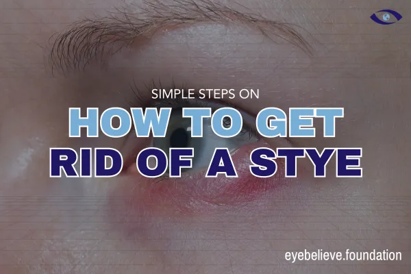 2 Simple Steps on How to Get Rid of A Stye