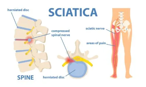 Sciatica Relief Through Chiropractic Care: A Holistic Approach to Healing