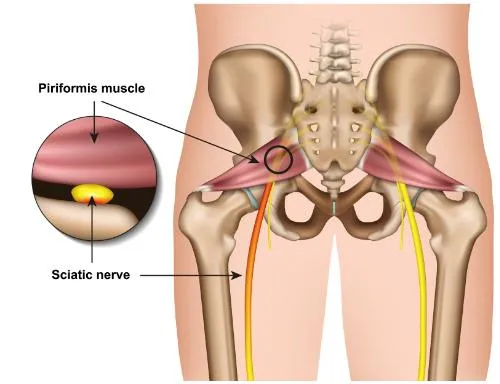 Overcoming Piriformis Syndrome with Chiropractic Care