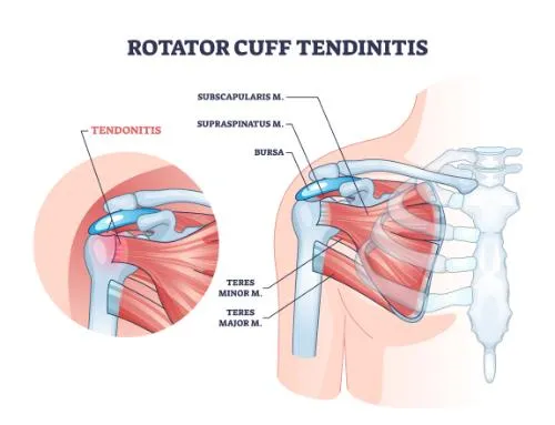 Why Chiropractic Care is a Great Choice for Rotator Cuff Tendinitis