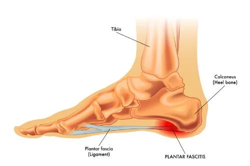 How to Overcome Plantar Fasciitis With Chiropractic Care