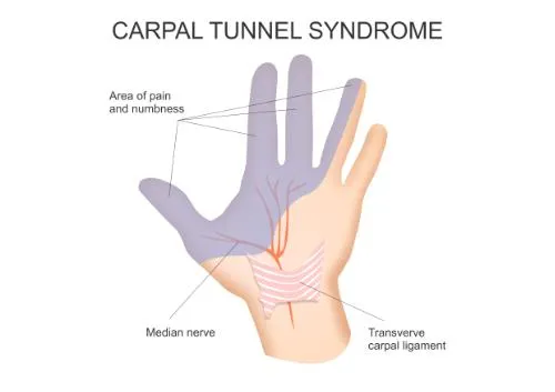 How To Conquer Carpal Tunnel Syndrome Using Chiropractic Care