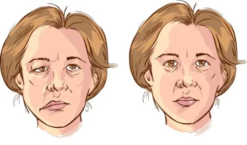 What Chiropractic Patients Want To Know About Bell’s Palsy