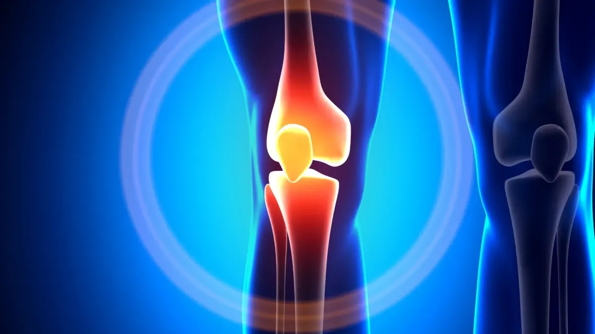 What is stage 4 CHRONIC KNEE PAIN?