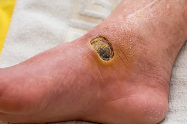 diabetic foot ulcer