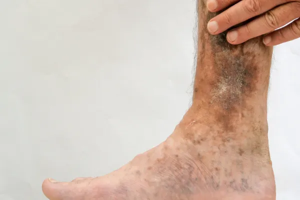 Early Treatment for Venous Leg Ulcers: Why It’s Critical for Healing
