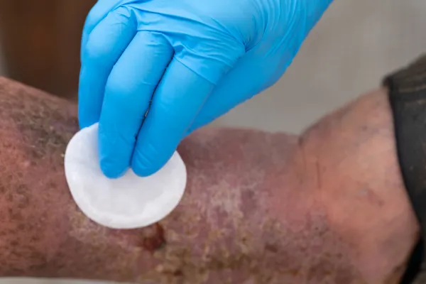 What Is Debridement—and Why Does It Help Wounds Heal?
