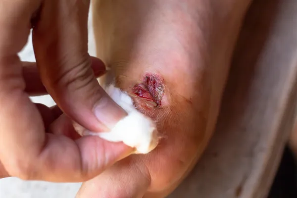 Why Early Wound Care Can Save You Time, Money, and Pain
