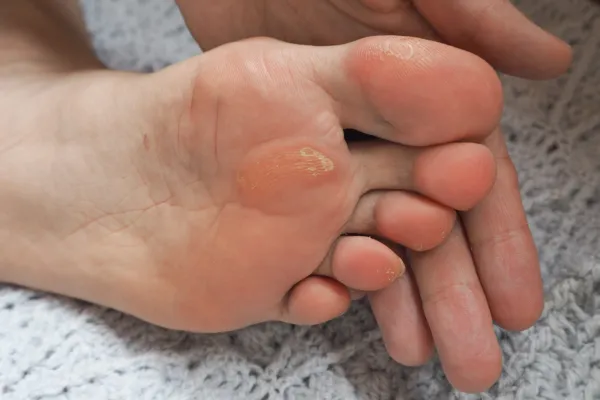 How to Tell If That Callus Might Actually Be a Pressure Sore