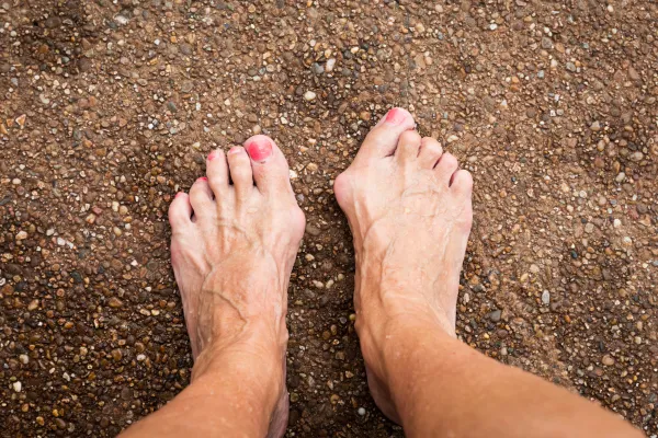 Hammer Toe: Why Your Toes Curl and What You Can Do