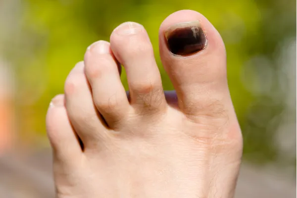 Why Your Toenails Keep Turning Black