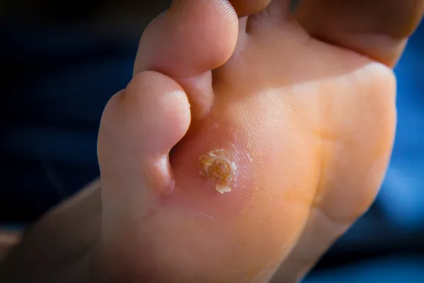Corns vs. Calluses: How to Tell the Difference and Treat Them