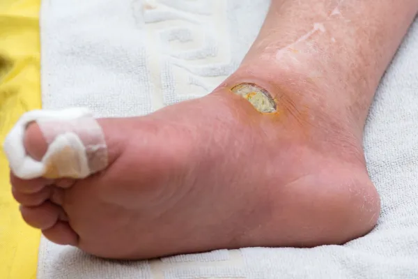 Signs Your Foot Wound Might Be Infected—and What to Do Next
