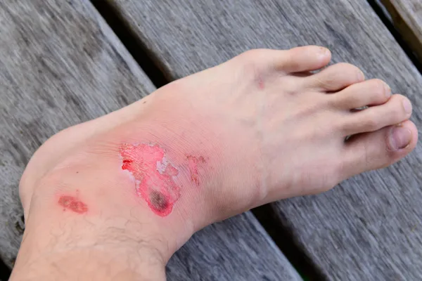 Why Your Foot Wound Might Keep Reopening (and How to Stop It)