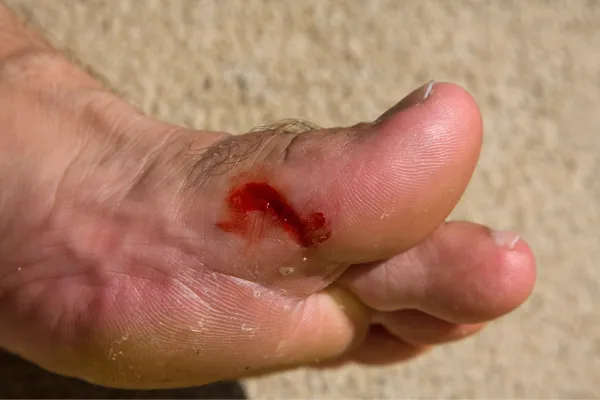 Moist Wound Healing vs. Dry: What Really Works Best?