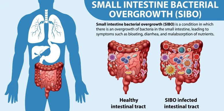 Small Intestine Bacterial Overgrowth Natural Treatment 