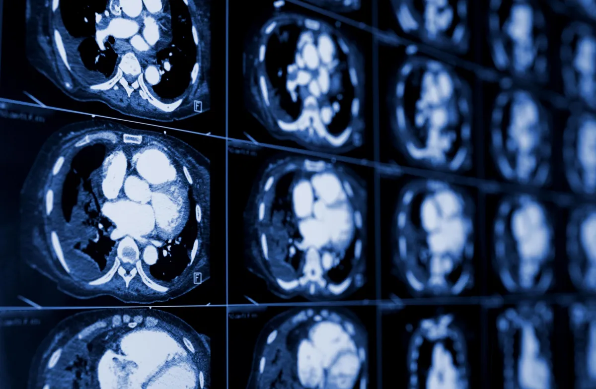 CT CHEST EXAM TYPES 