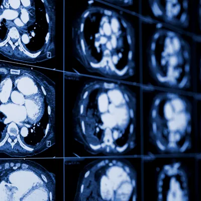CT Scans of the chest 