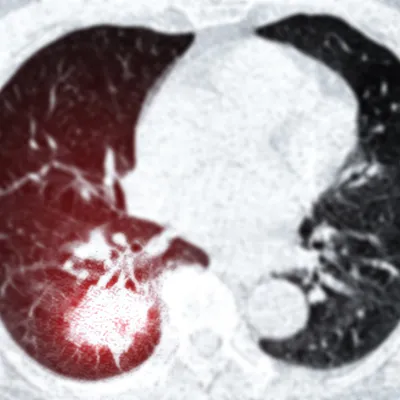 Lung Cancer CT