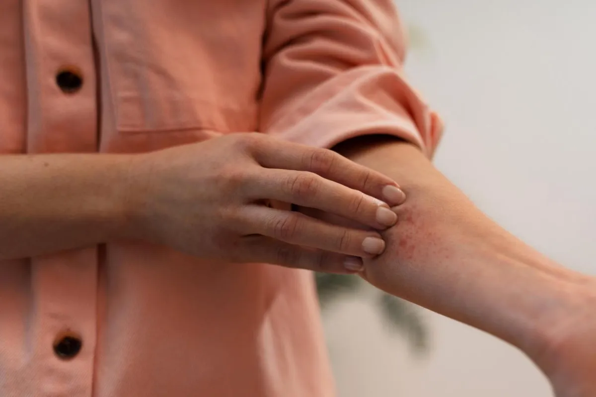 snake bite