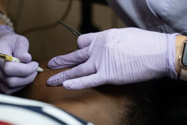 How to Prepare for Your Electrolysis Appointment: What to Do (and Avoid) for the Best Results