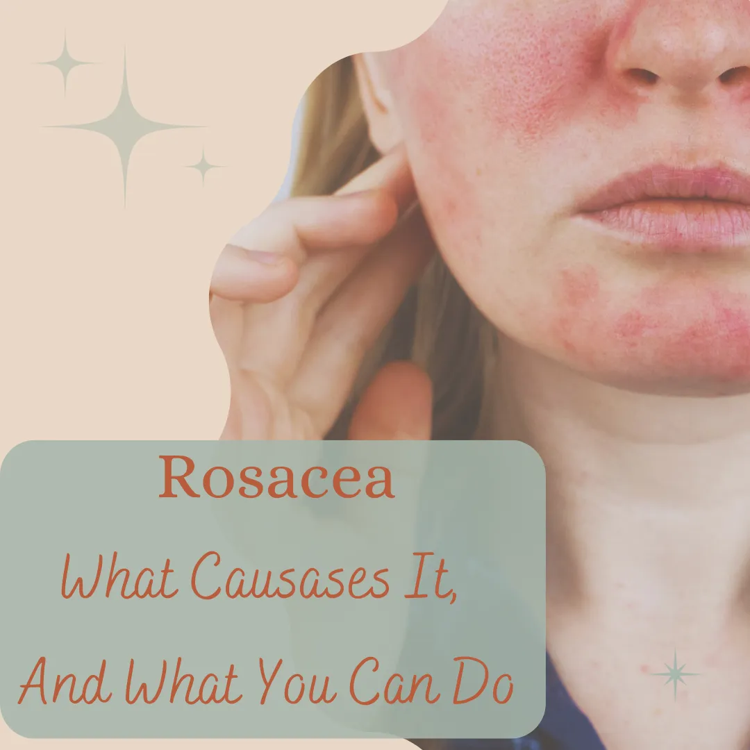 Let's Talk Rosacea: Causes. Care. and Calming Your Skin