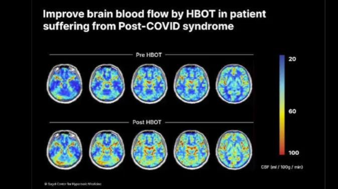 Breathing New Life into Long COVID Recovery: How Hyperbaric Oxygen Therapy Could Help