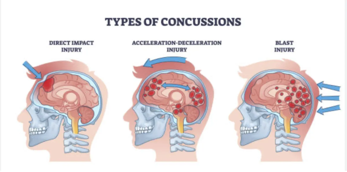 Concussion Cover image