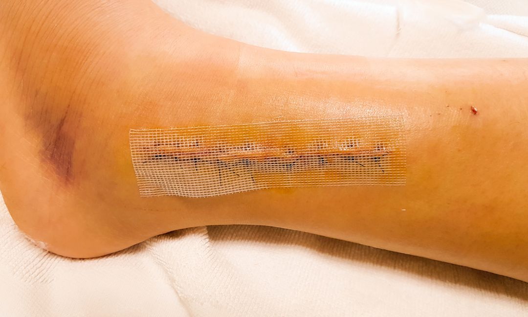 Complications after ankle replacement