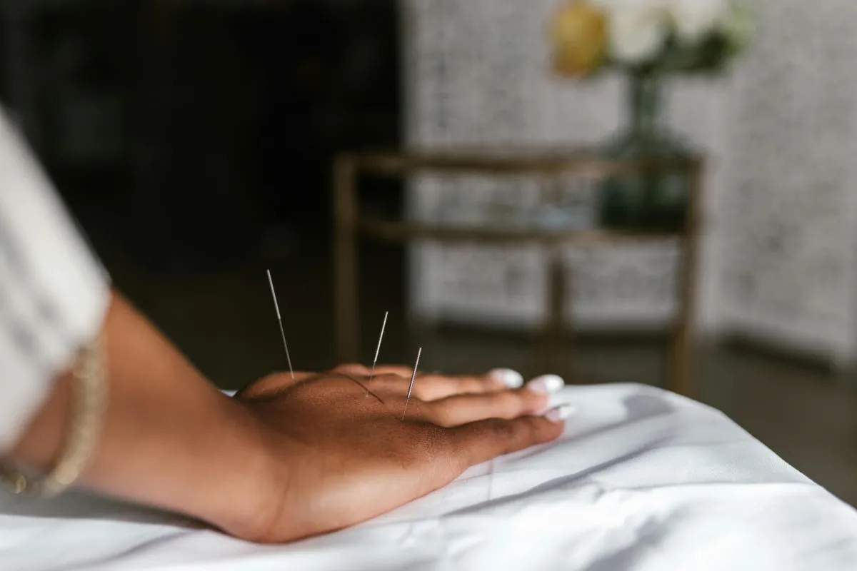 Acupuncture for Pain Relief and Healing: What You Need to Know