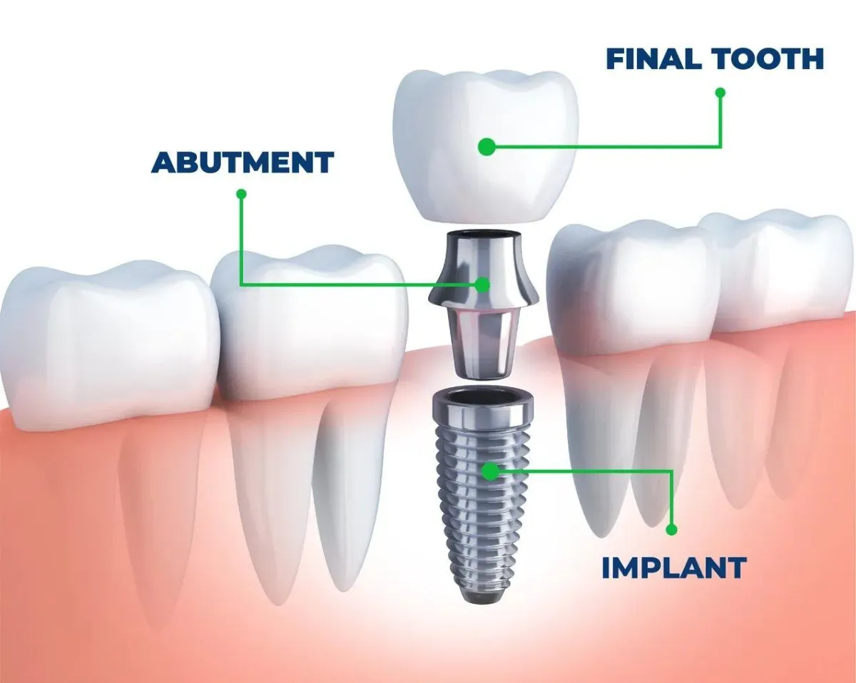 Best Place for Dental Implants Near Me