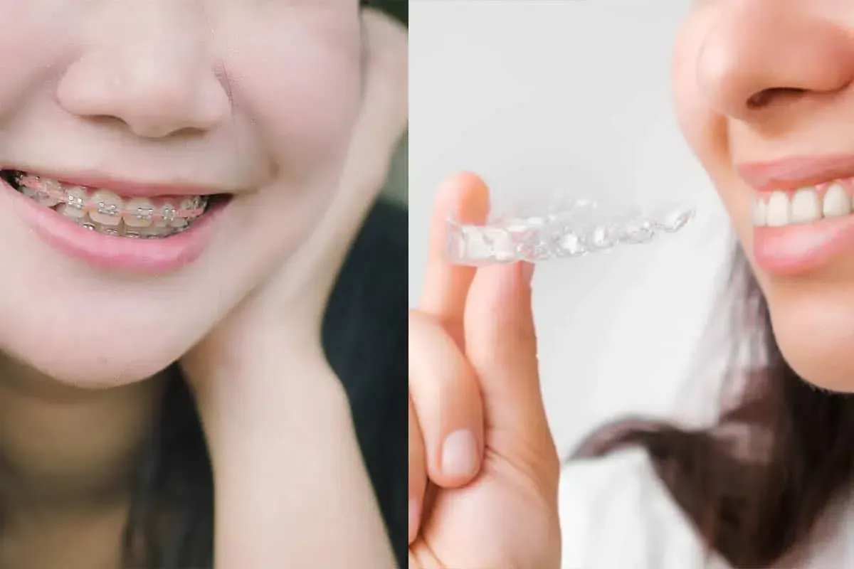 Braces vs Clear Aligners