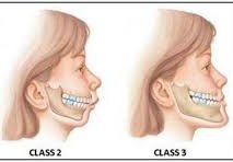 Class II vs Class III