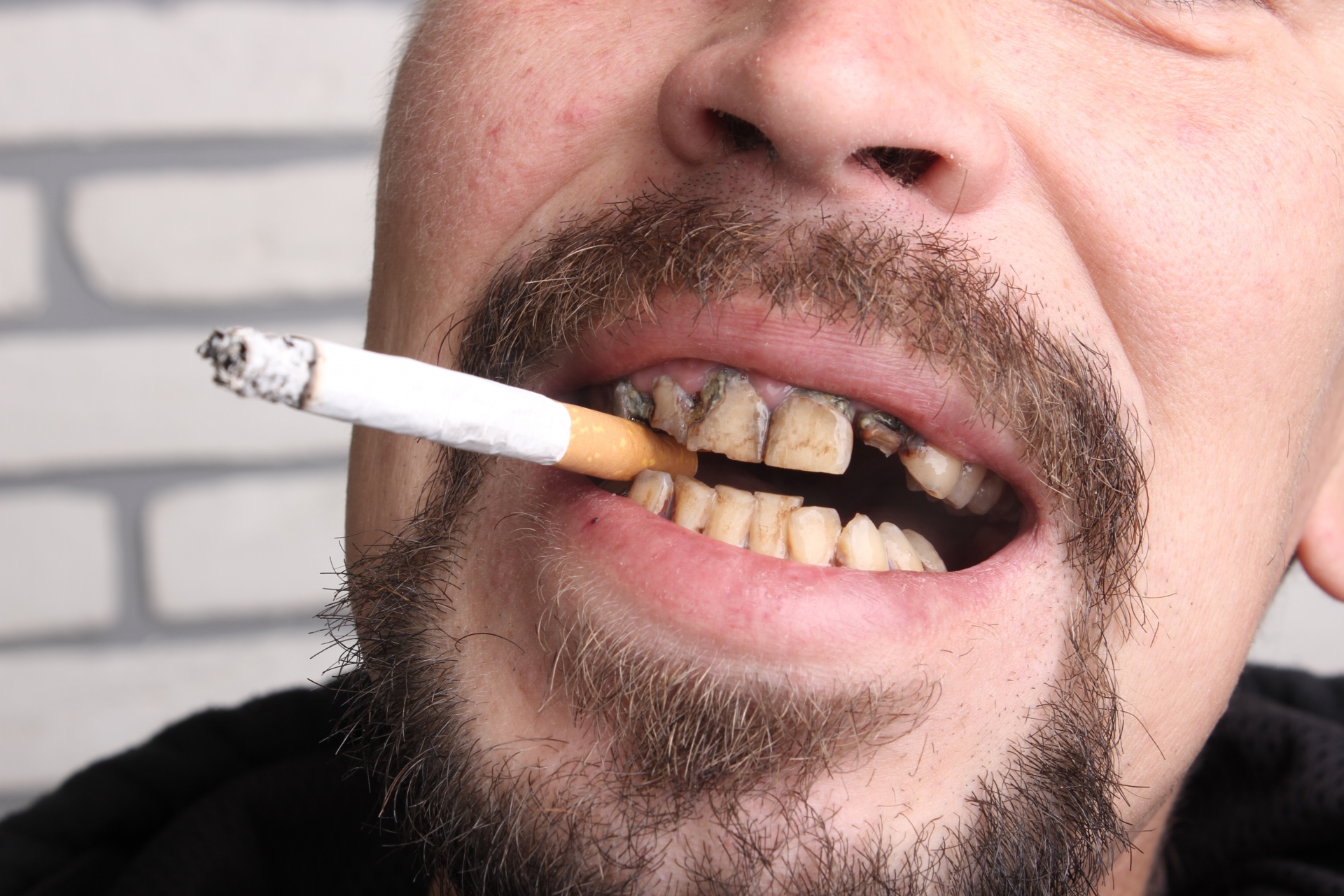 Smoking and Oral Health