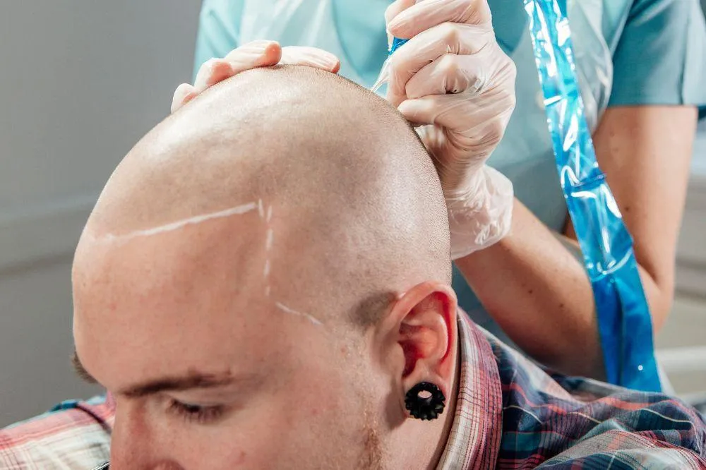 Everything You Need to Know About Scalp Micropigmentation for a Confident New Look