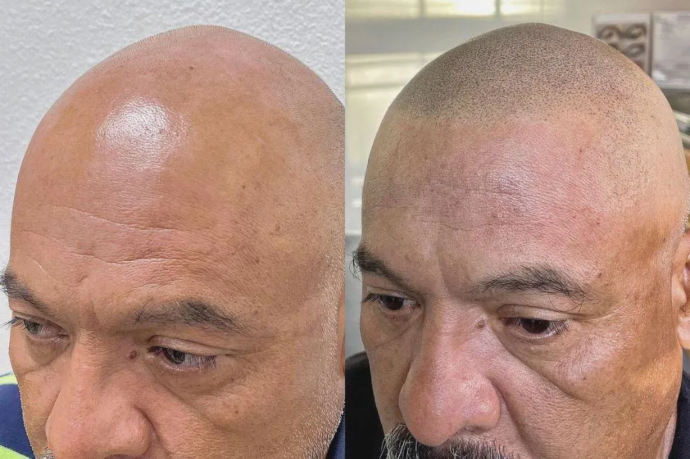 How Scalp Micropigmentation Can Help You Love Yourself Again