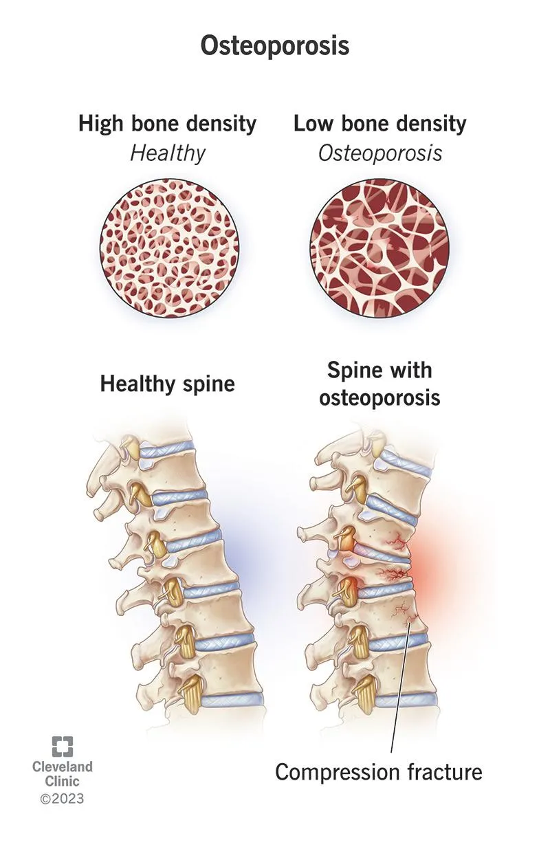 Strengthen Your Bones, Strengthen Your Life