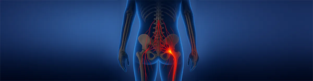 Sciatica and Chiropractic