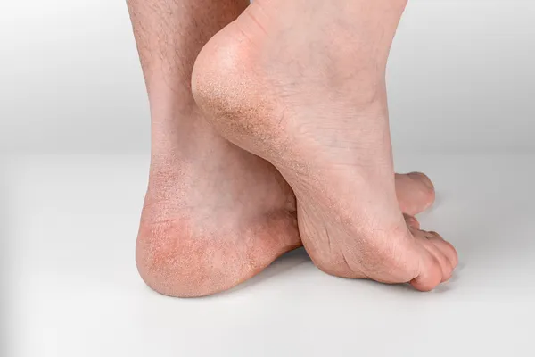 Footcare-Calluses