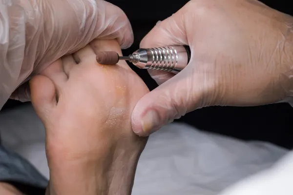 Corns vs Calluses: What’s the Difference and Why It Matters for Your Feet