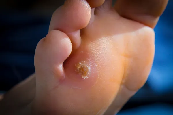 Why Do I Keep Getting Corns on My Feet? Common Causes Explained