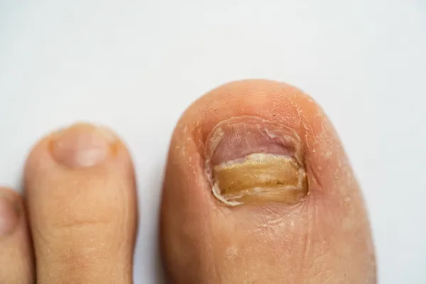 Fungal Nails: What Causes Them and How to Get Rid of Them
