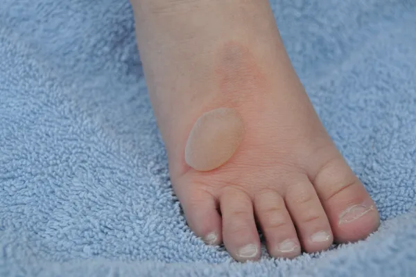 Is That Lump on Your Foot a Ganglion Cyst? Here’s What to Know